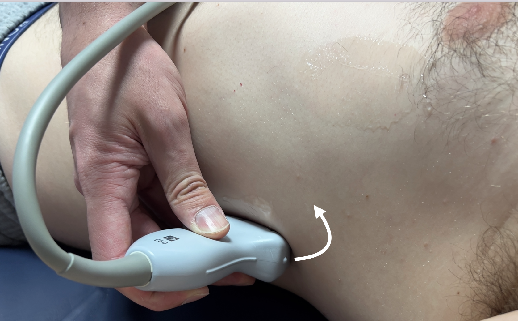 How to Scan the Renal Tract :: POCUS